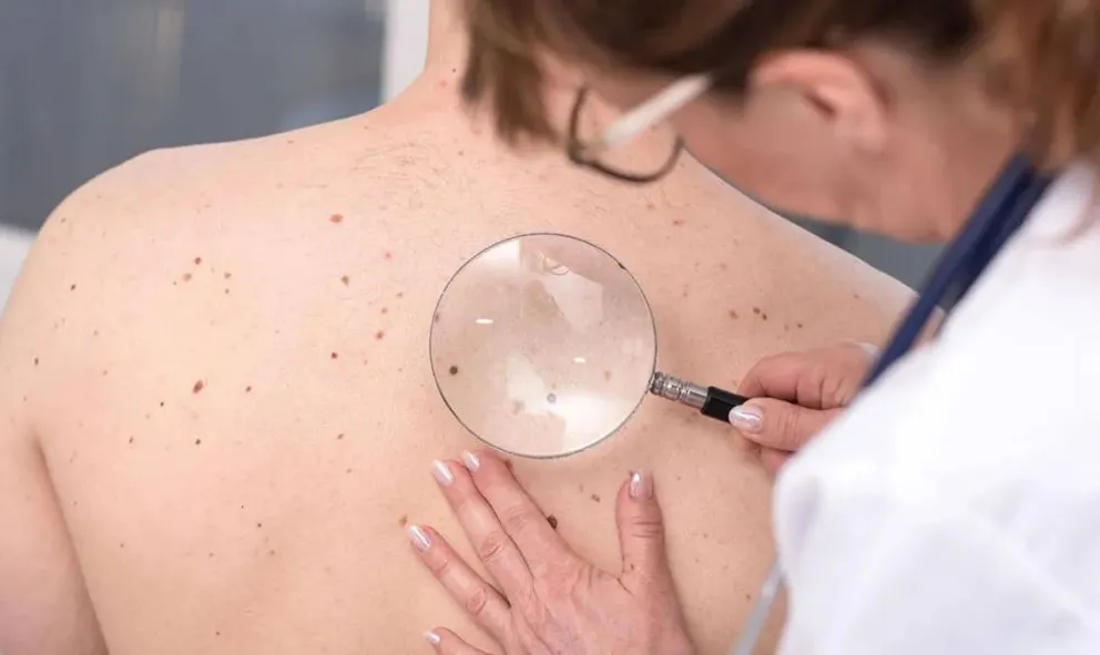 Campaña de prevención del cáncer de piel: controles gratuitos en Cipolletti