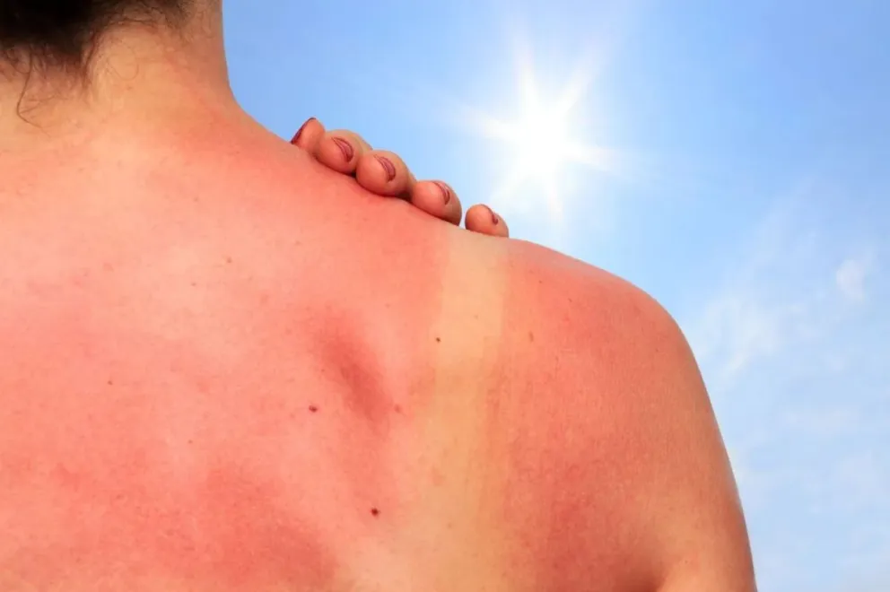 La radiación UV llegó al nivel extremo y recomiendan no exponerse al sol mas de 10 minutos
