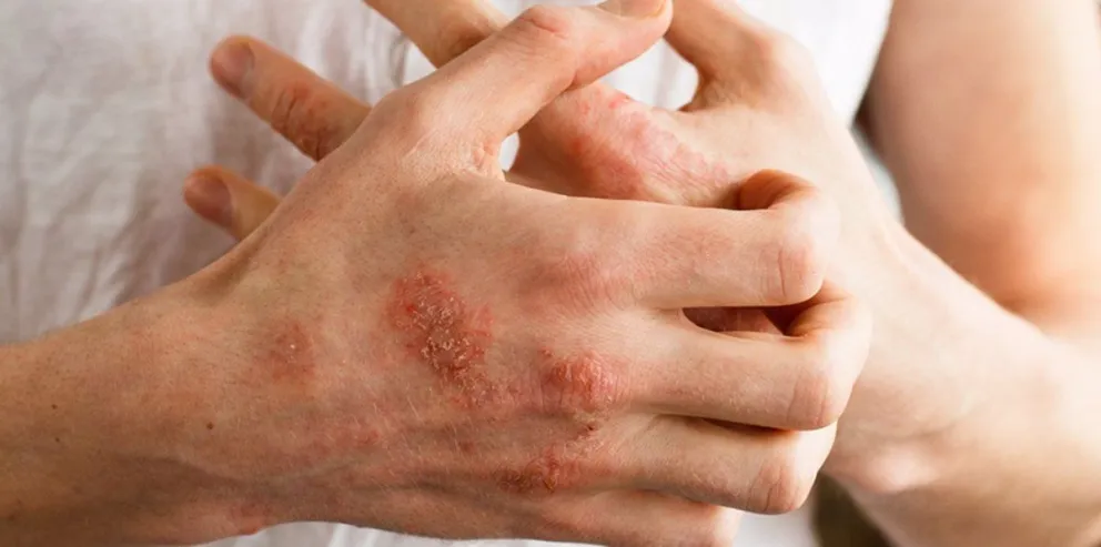 Padece una enfermedad autoinmune y organizan una campaña solidaria para ayudarla