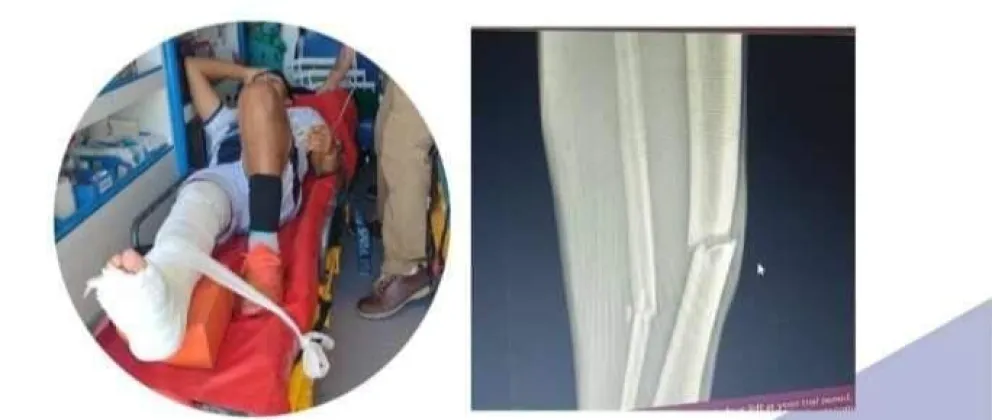   Se fracturó el pie, necesita una intervención quirúrgica urgente y su familia realizó una colecta solidaria