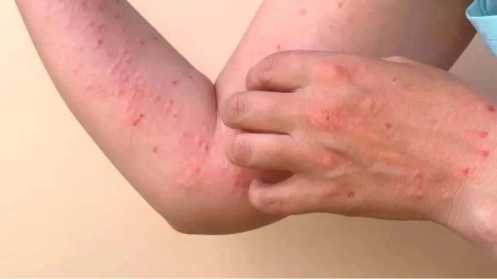 Dengue en Argentina: se reportaron 36 mil contagios y 36 muertos en la última semana