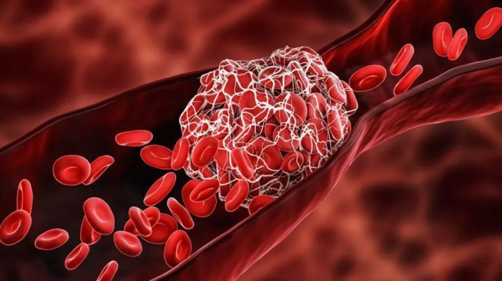 Qué es la trombosis, el efecto secundario que puede causar la vacuna AstraZeneca contra el Covid