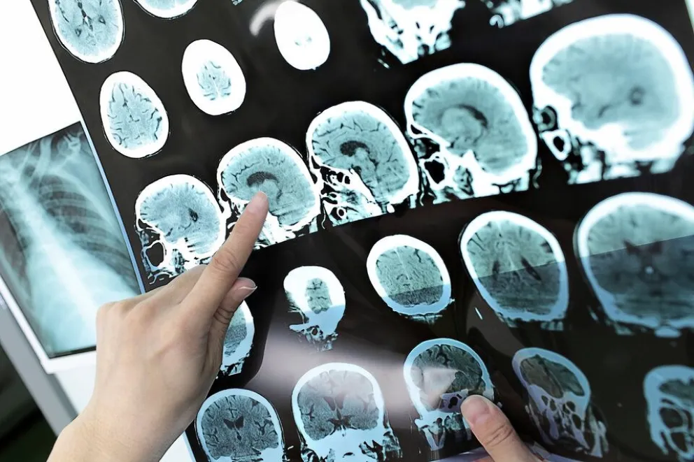 Avances en la detección temprana del Alzheimer: Un gen indicador del desarrollo de la enfermedad