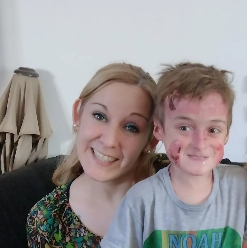 Qué es “piel de cristal”, la enfermedad que afecta a Noah, un niño cipoleño