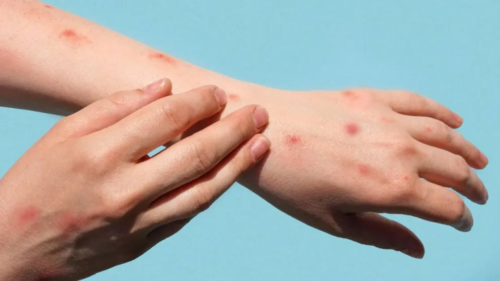 Viruela del mono: se detectó el primer caso en Rio Negro 