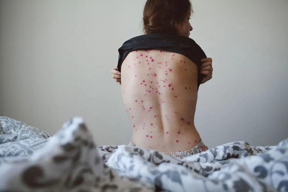 Viruela del mono en Argentina: conoce sobre los casos y los síntomas