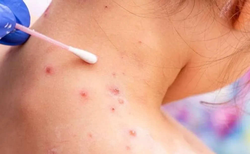 Viruela del Mono en Cipolletti