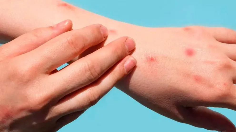 Sexto caso de viruela del mono en Argentina: ya son 4 las provincias afectadas