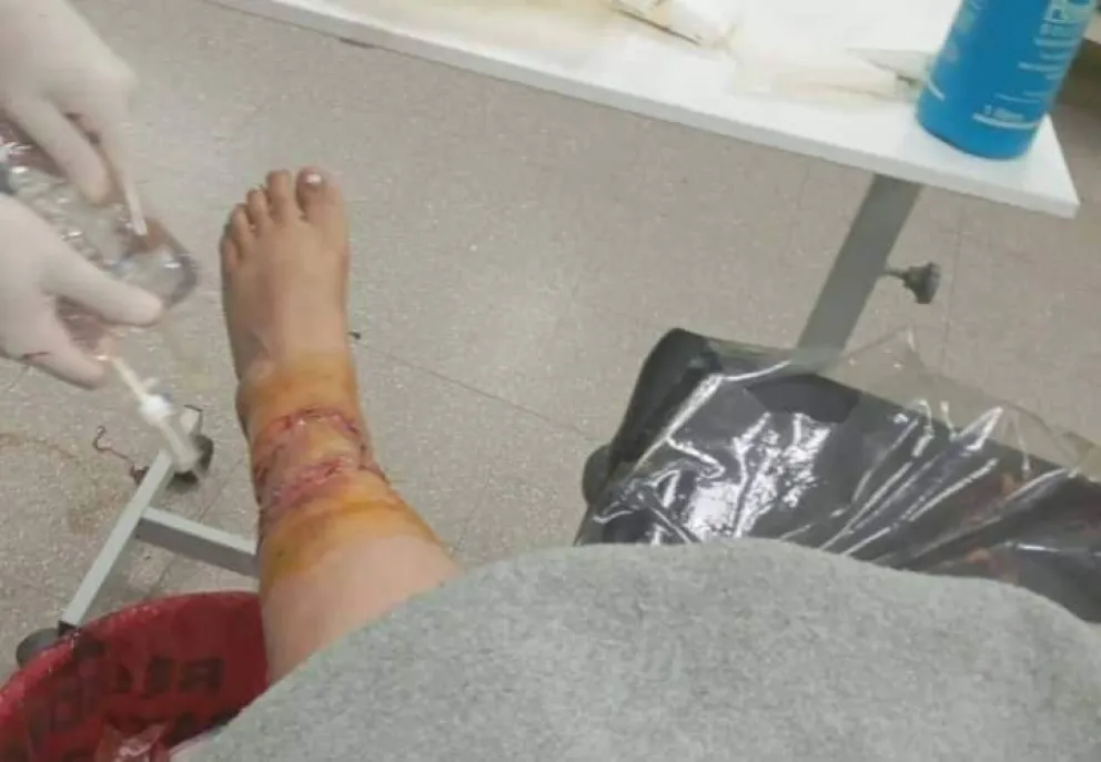 Vecina atacada por perros