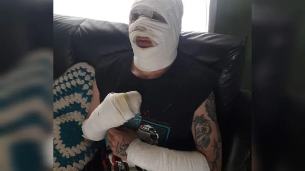 hombre con quemaduras