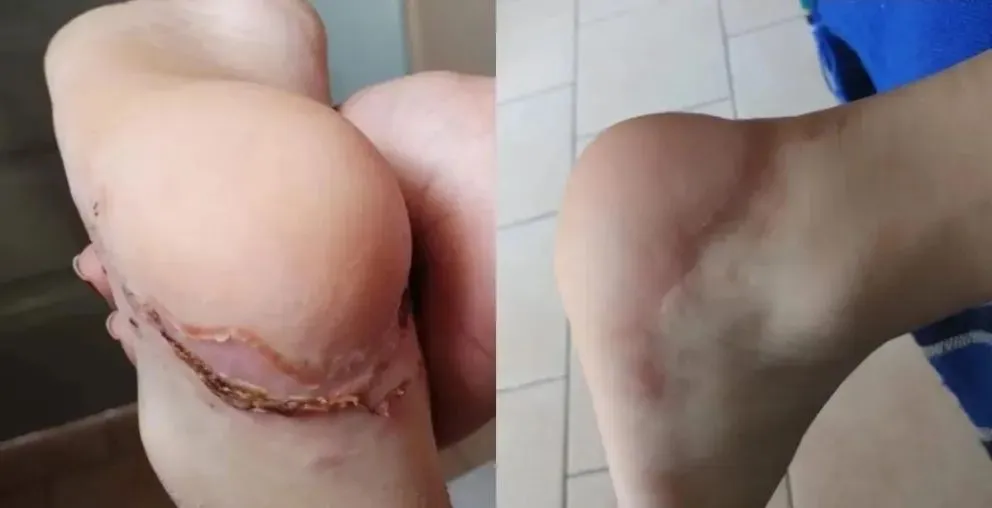 Familia de un joven agredido en las 827 hará un bingo y donará todo a un niño que debe operarse para volver a caminar