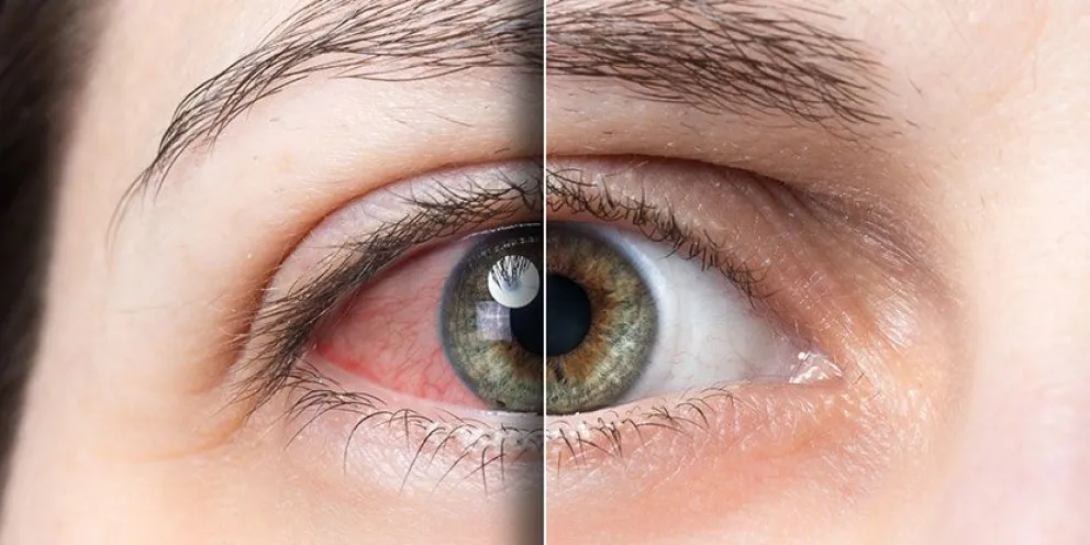 El ojo seco es una afección ocular frecuente que se produce cuando el ojo no genera suficientes lágrimas (imagen archivo)