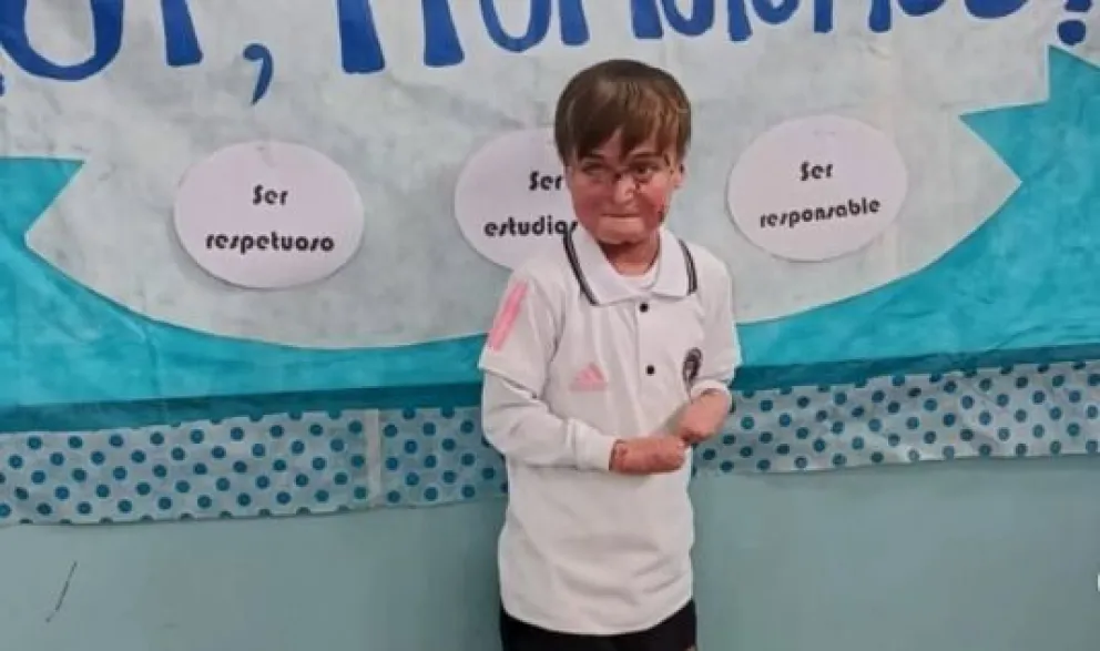 Noah es un niño de Cipolletti y nació con Piel de Cristal. | Foto  gentileza