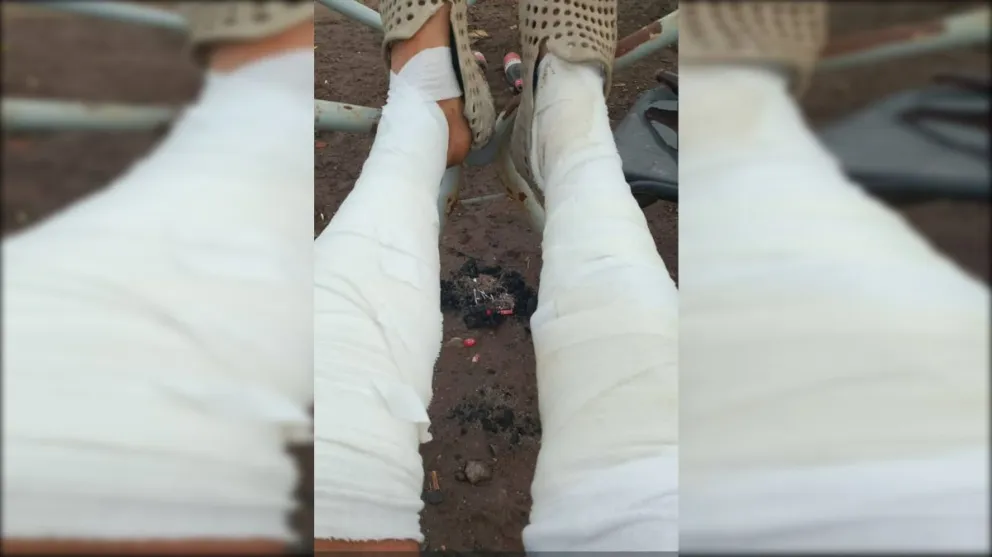 Así han quedado las piernas del hombre que intentó salvar a su familia y sus pertenencias en el fuego.
