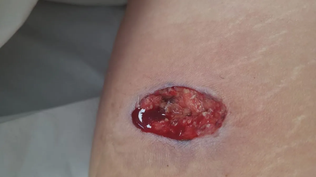 picadura de Ara&ntilde;a