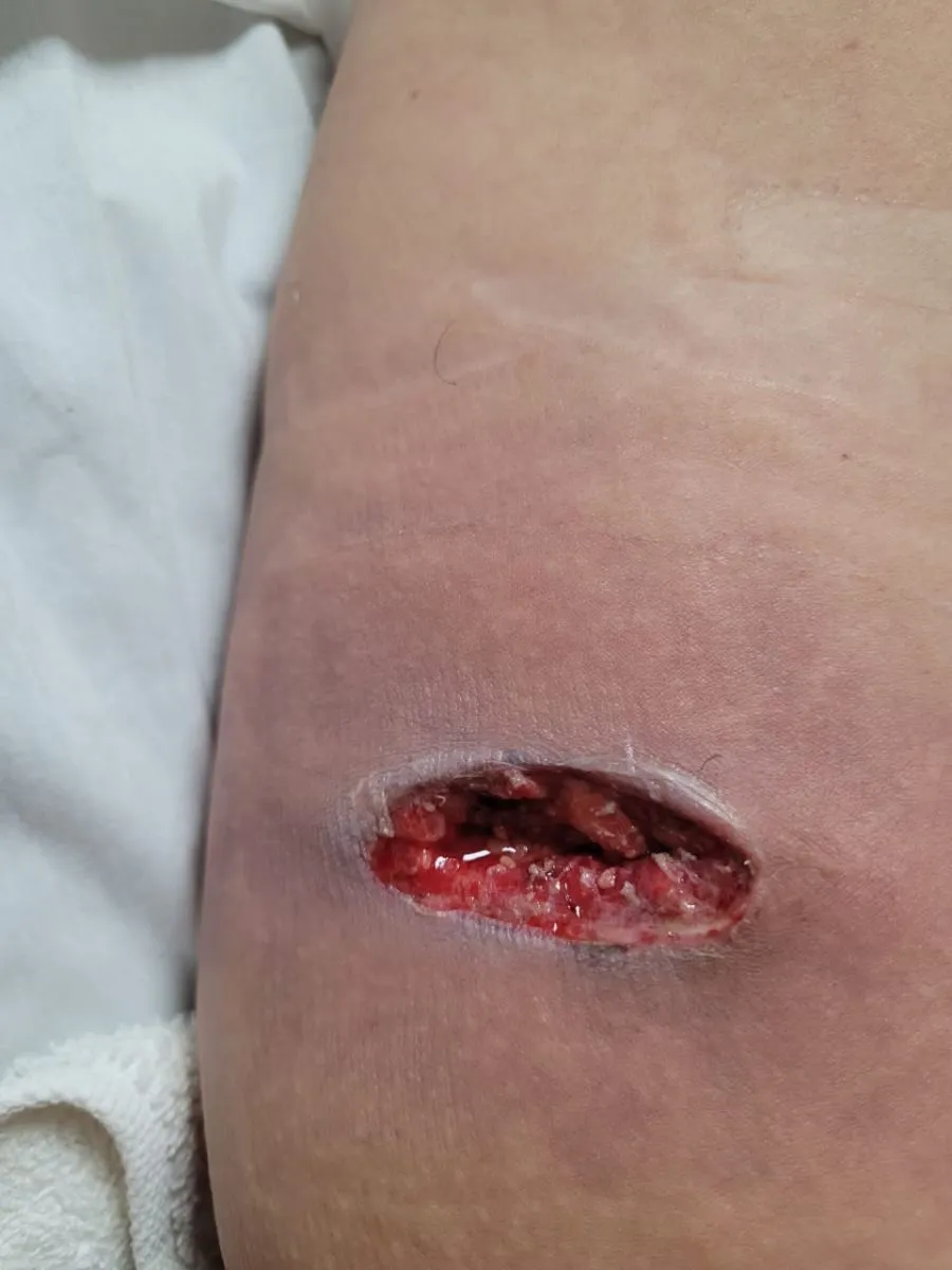 picadura de ara&ntilde;a