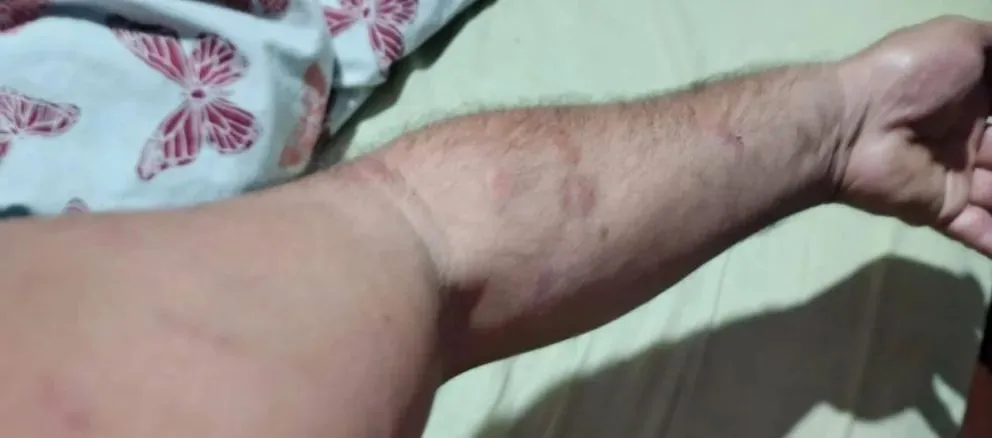 Varias personas presentar importantes lesiones tras el granizo. Foto gentileza