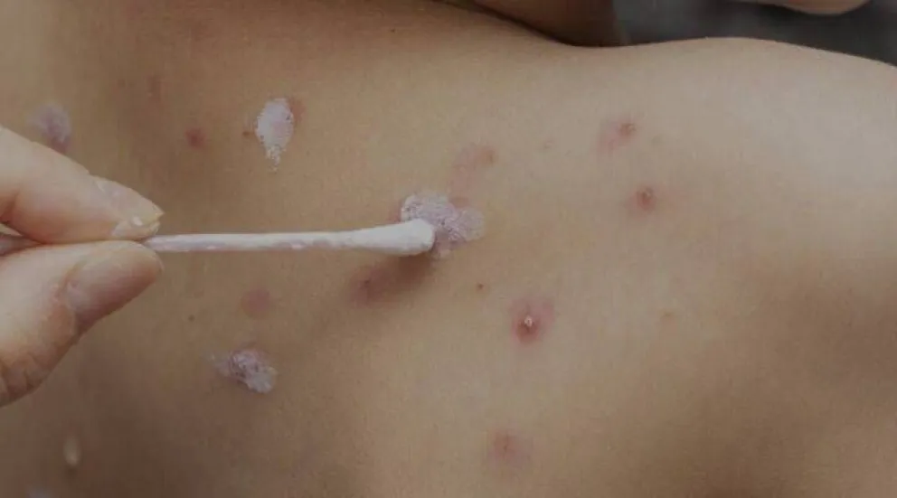 La varicela es una enfermedad viral, que provoca fiebre alta y la aparición de ampollas llenas de líquido en la piel. Foto: archivo.