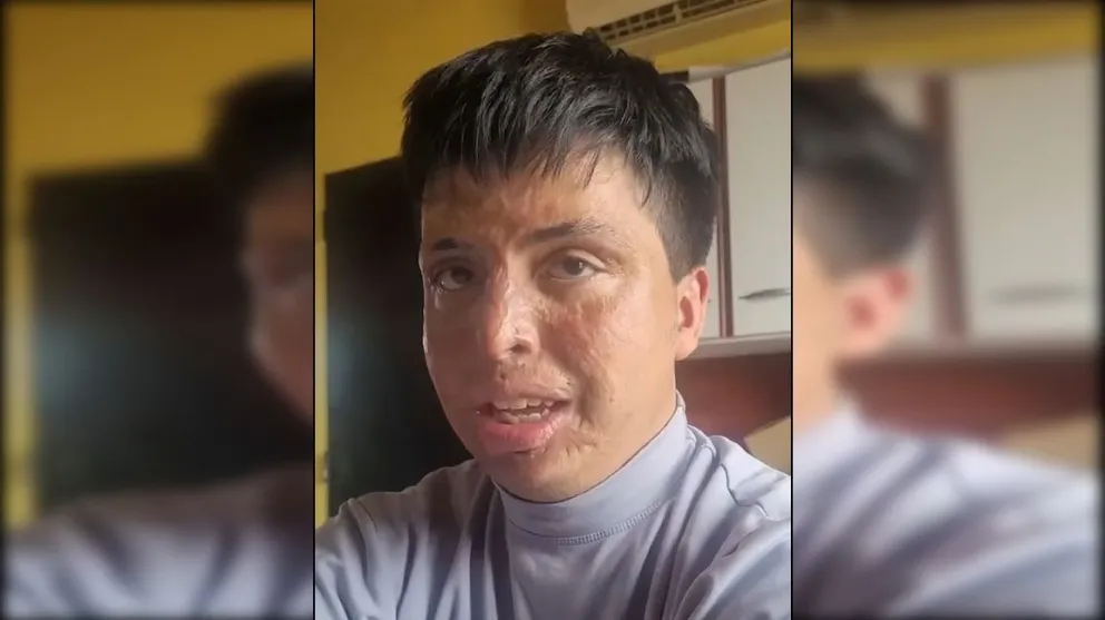 Joaquín logró rescatar a dos hermanitos del incendio pero pagó un alto precio: estuvo seis meses en terapia intensiva con más del 75 % del cuerpo quemado. Foto: gentileza.